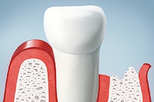 Imagen Cirugía periodontal 