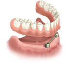 Imagen Prótesis sobre implantes