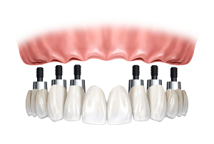 Imagen Prótesis sobre implantes
